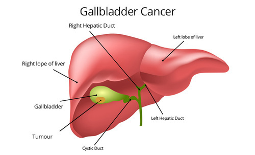 A Guide to Gallbladder Cancer